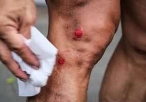 Treating-A-Wound-Image1